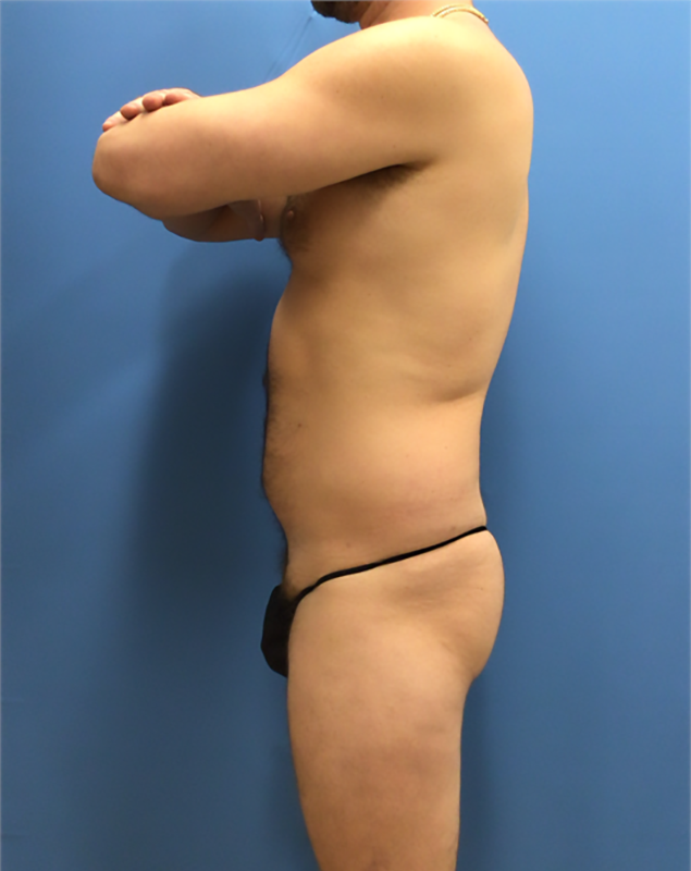 Before - Left Profile