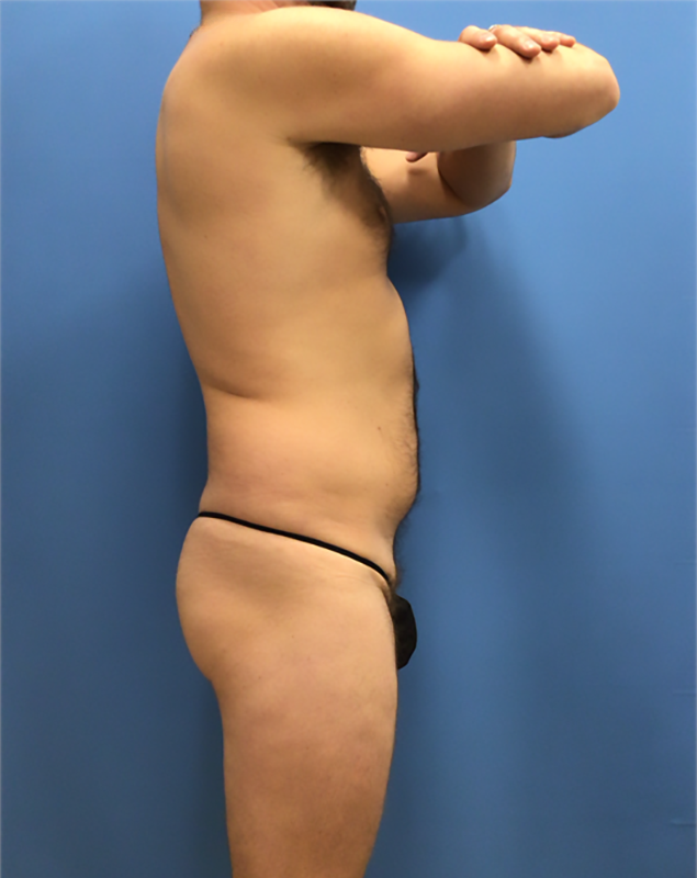 Before - Right Profile