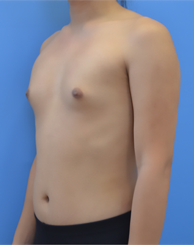 Before - Left Profile