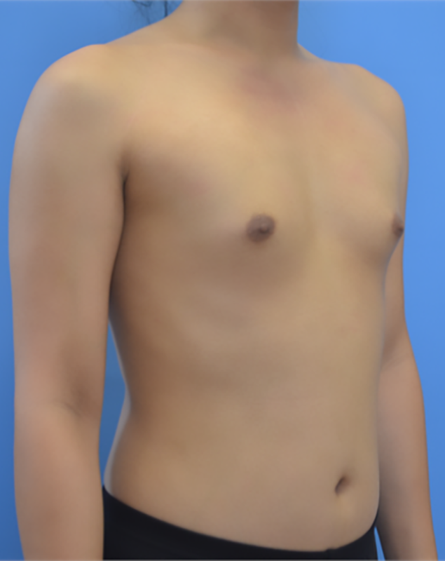 Before - Right Profile